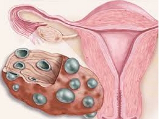Синдром  поликистозных яичников 