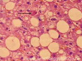 Токсическая дистрофия печени