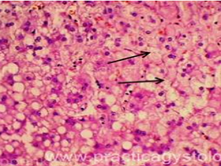 Гидропическая дистрофия печени