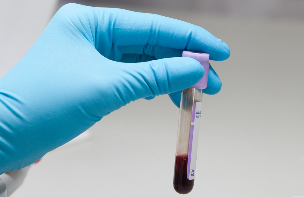 Биохимические пробы. Пробирки с кровью. Исследование проб крови. Биохимическая пробирка для крови. Забор крови на биохимическое исследование.