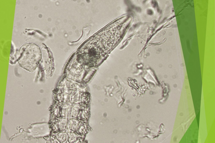 Сочетанный демодекоз с редкой локализацией
